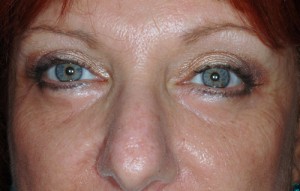 Female Eyelid Surgery