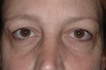 Female Eyelid Surgery