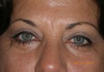 Female Eyelid Surgery