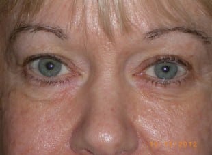 Patient 150 - Before View 