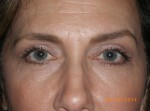 Female Eyelid Surgery