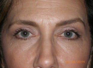 Patient 151 - After View 