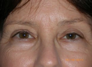 Patient 152 - Before View 