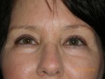 Female Eyelid Surgery