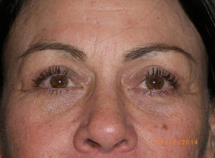 Patient 153 - After View 