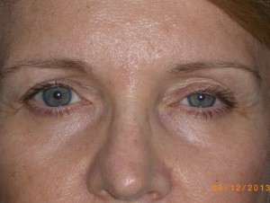 Female Eyelid Surgery