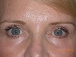 Female Eyelid Surgery