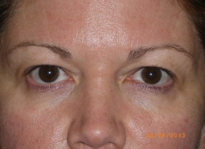 Female Eyelid Surgery