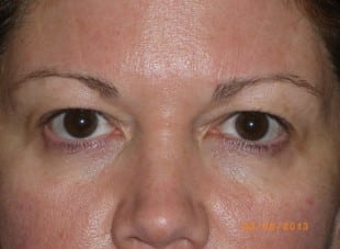 Patient 155 - Before View 