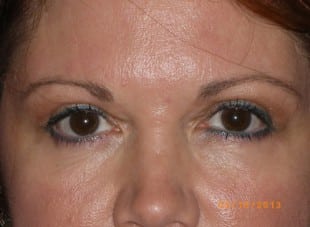 Patient 155 - After View 