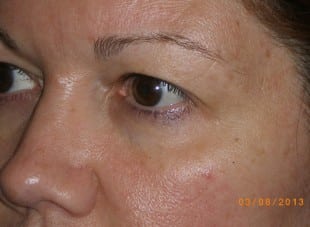 Patient 155 - Before View 