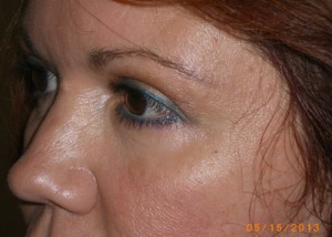 Female Eyelid Surgery