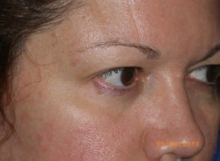 Patient 155 - Before View 