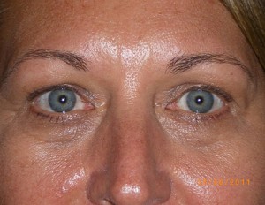 Female Eyelid Surgery