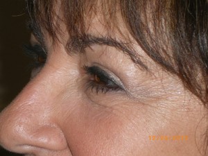 Female Eyelid Surgery