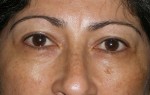 Female Eyelid Surgery