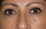 Female Eyelid Surgery