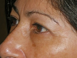 Female Eyelid Surgery