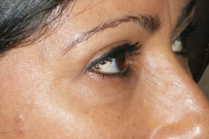 Female Eyelid Surgery