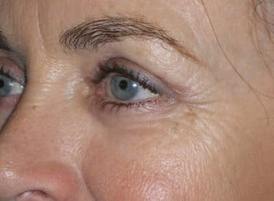 Patient 160 - After View 