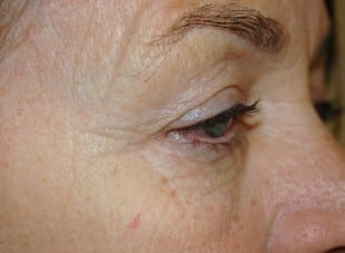 Patient 160 - Before View 