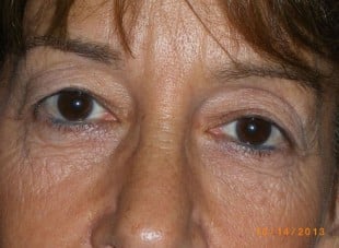Patient 161 - Before View 