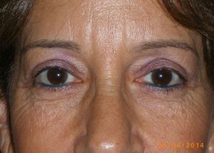 Female Eyelid Surgery