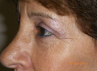 Patient 161 - After View 
