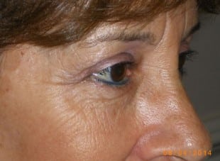 Patient 161 - After View 