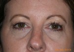 Female Eyelid Surgery