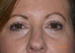 Female Eyelid Surgery