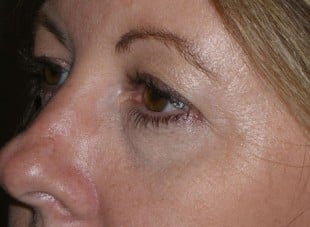 Patient 162 - Before View 