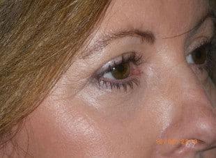 Patient 162 - After View 