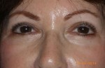 Female Eyelid Surgery