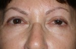 Female Eyelid Surgery