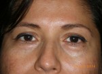 Female Eyelid Surgery