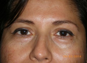 Female Eyelid Surgery