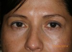 Female Eyelid Surgery