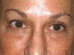 Female Eyelid Surgery