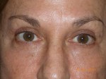 Female Eyelid Surgery