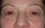 Female Eyelid Surgery