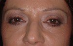 Female Eyelid Surgery