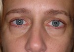 Female Eyelid Surgery