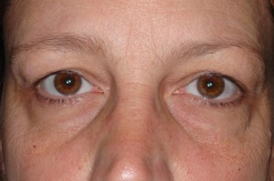 Female Eyelid Surgery