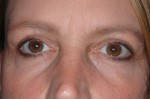 Female Eyelid Surgery