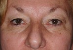 Female Eyelid Surgery