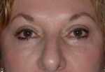 Female Eyelid Surgery