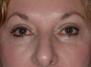 Patient 169 - After View 