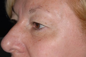 Female Eyelid Surgery