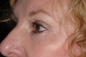 Female Eyelid Surgery